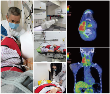 2025中國BNCT新啟航新突破！18F-BPA獲批IND，BPA啟動臨床Ib